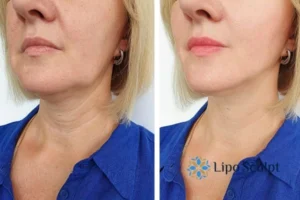 Double chin before and after Hi-Fu treatment 4 Book your double chin treatment Ruislip today! We are here to help!
