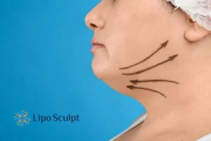 Double chin before and after Hi-Fu treatment 3 Boost your confidence with a Double chin treatment Ruislip