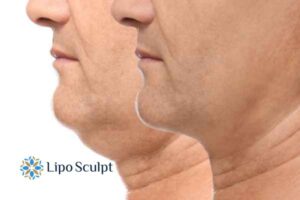 Double chin before and after Hi-Fu treatment 2 Double chin treatment Ruislip from Lipo Sculpt - feel more confident today!