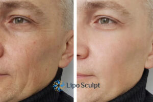 How to Fight Aging Symptoms 3 Fight Aging Symptoms Ruislip With HIFU and Morpheus8 Today!
