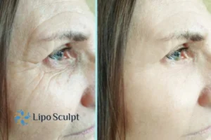 How to Fight Aging Symptoms 2 Do you want to Fight Aging Symptoms Ruislip? Contact Lipo Sculpt today!