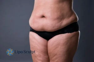 Cellulite's 5 Most Common Causes 4 Feel more confidence with your cellulite Ruislip treatment today!