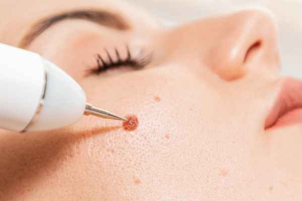 CryoPen: 5 Skin Concerns It May Be Used to Treat 3 What actually happens during a CryoPen treatment Ruislip?