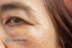 Cryopen: The Revolutionary Treatment for Age Spots Unveiled 2 Are age spots Ruislip giving you low self esteem? Contact us today!