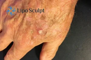 Best Actinic Keratoses Removal 2 Improve your wellbeing and health with Actinic Keratoses Ruislip removal.treatment