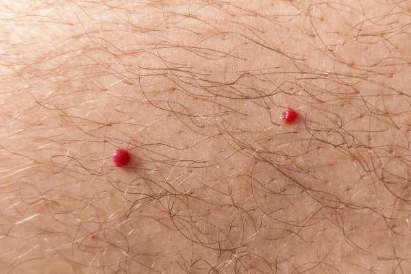 CryoPen: 5 Skin Concerns It May Be Used to Treat 2 cherry angioma removal Ruislip