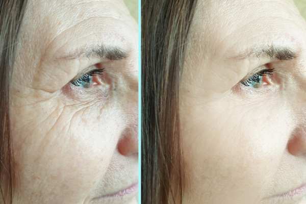 Why Do People Choose HIFU for a Non-Surgical Facelift? 4 How long can HIFU results last Ruislip?
