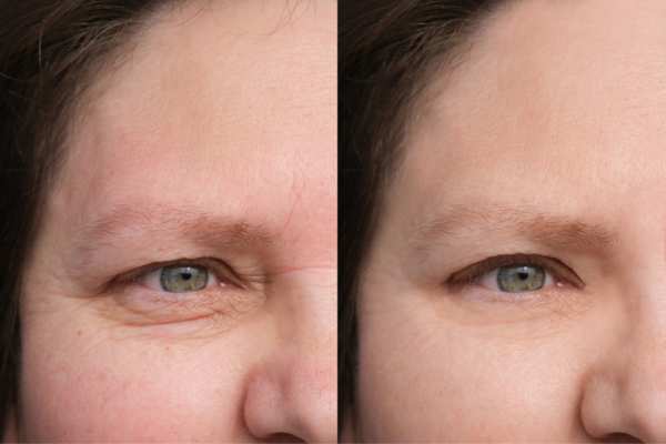 HIFU vs Botulinum Toxin: Understanding the Differences 4 How long do HIFU results last Ruislip?