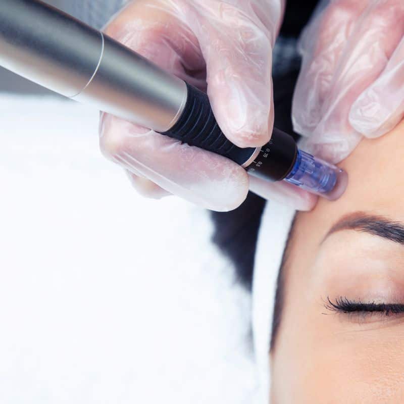 Morpheus8 treatment Ruislip from Lipo Sculpt - Book in today!