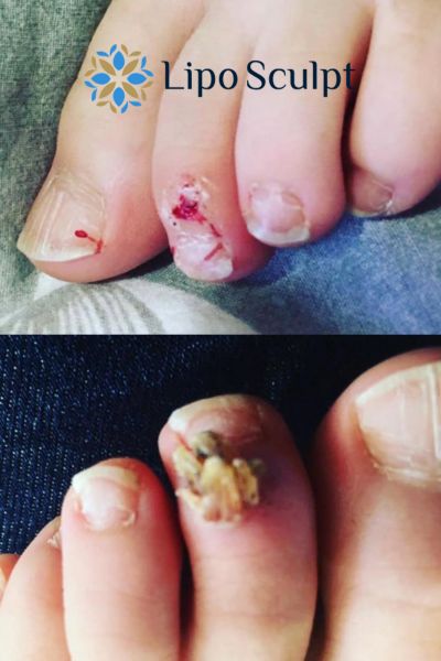 Wart removal customer results from Lipo Sculpt Ruislip