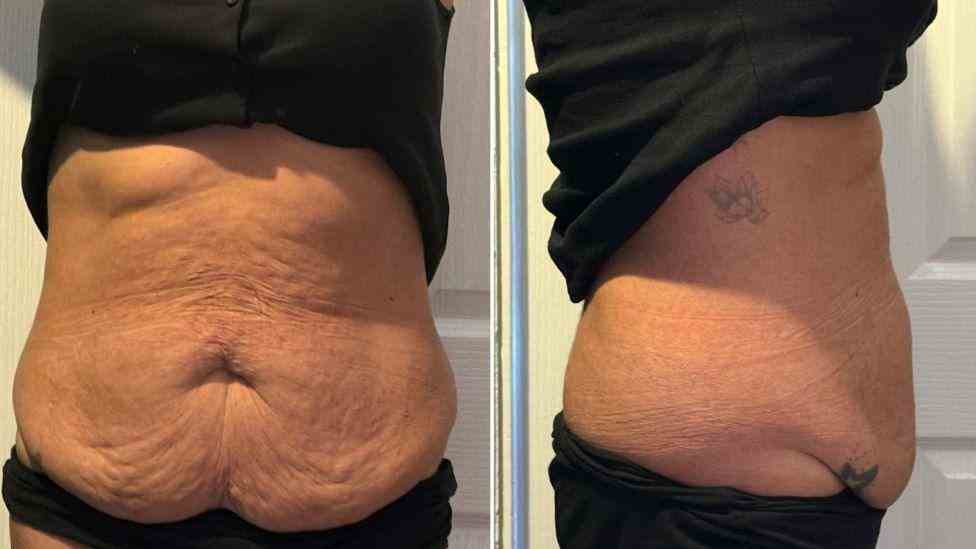 Lost the Weight but Not the Loose Skin? What You Should Know 1 Is It Definitely Loose Skin Ruislip?