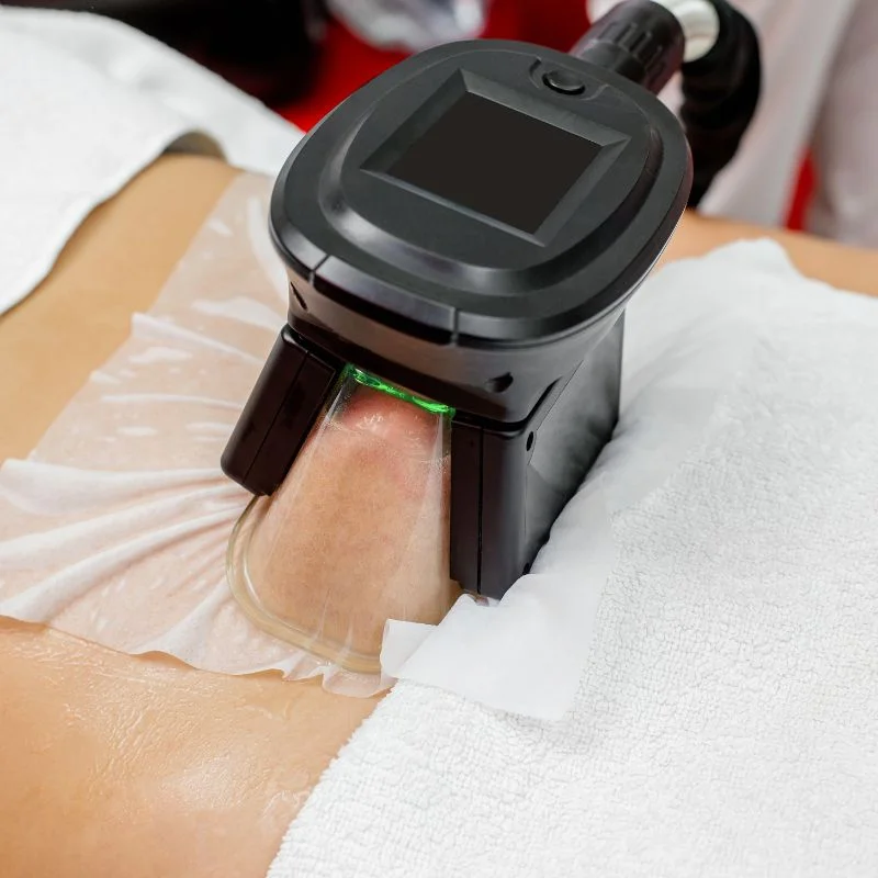 Fat Freezing treatment Ruislip